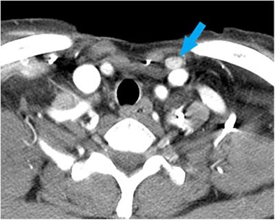 Case Report: Two cases of recurrences at the suprasternal space and lymph nodes between the sternocleidomastoid and sternohyoid muscles in papillary thyroid carcinoma